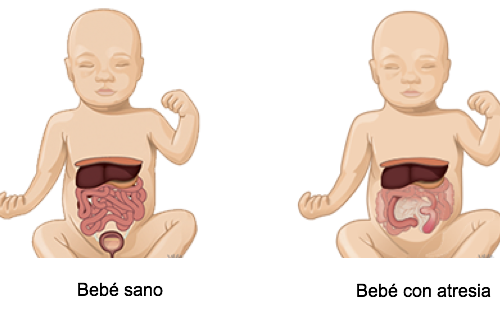 Atresia intestinal