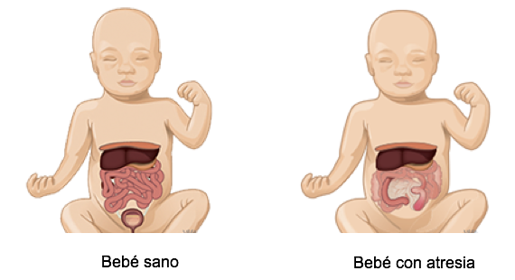 Atresia intestinal