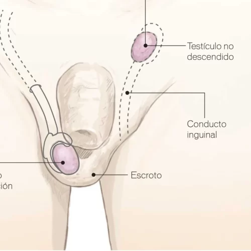 Testículos no descendidos